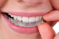 Orthodontics/invisalign - iSmile  