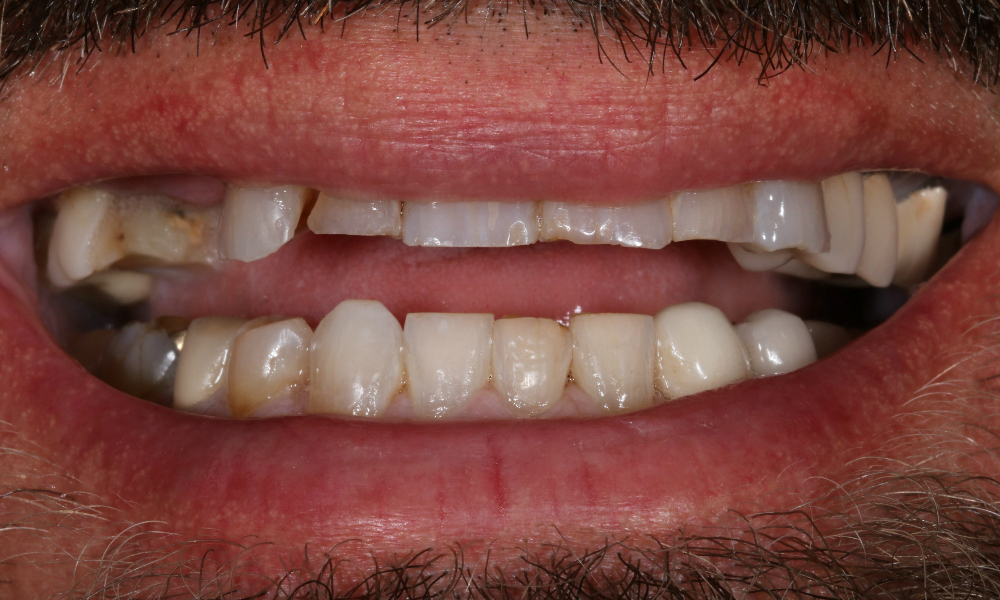 Case 11 PreOp