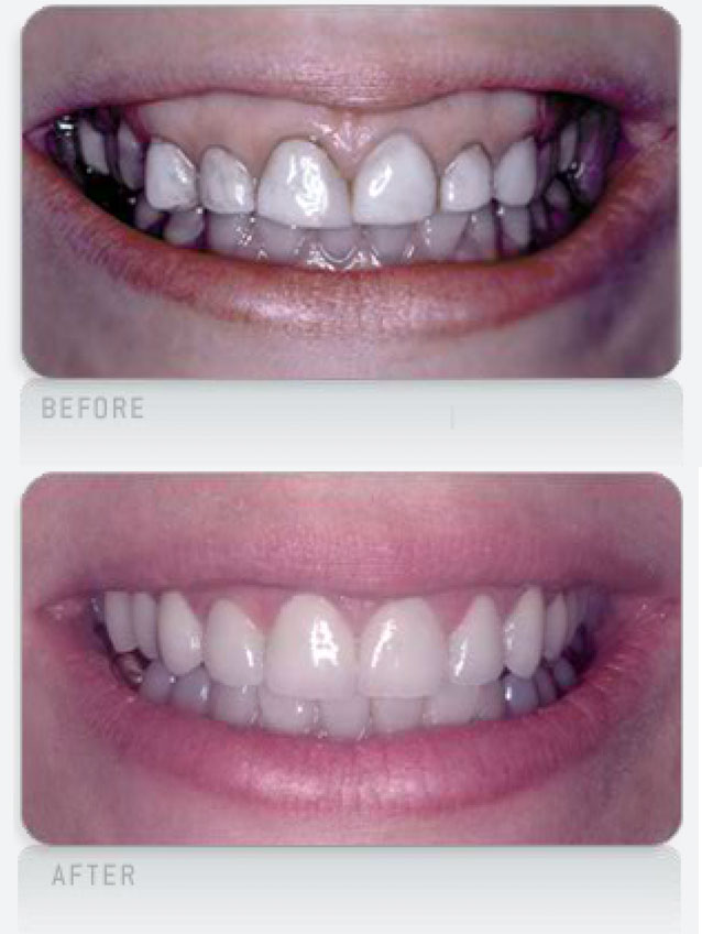 Gummy-Smile