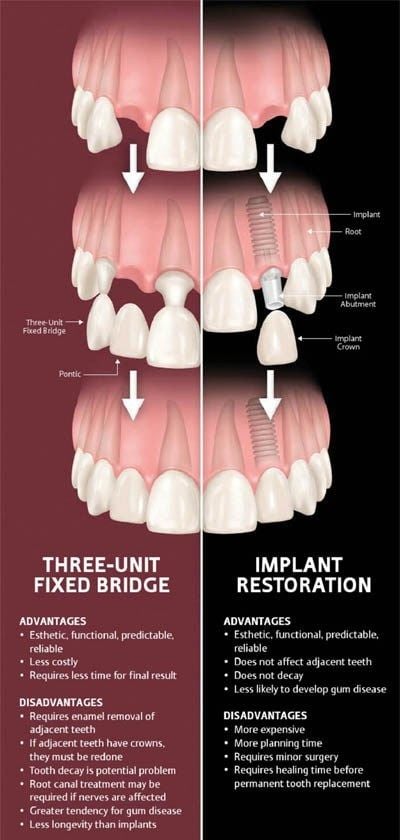 Implant-vs-Bridge-2_27ed9b35a39cfa75c0eba12ef9736eea