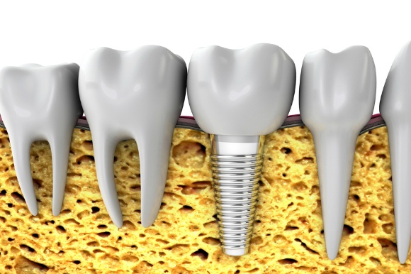 Ismile - Dental Implants