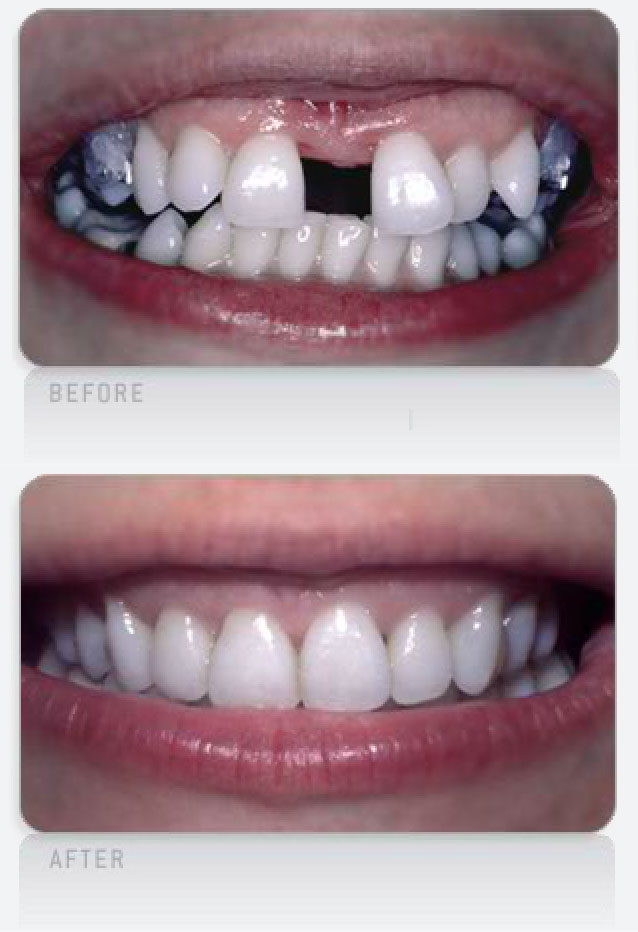 Spaced-Teeth