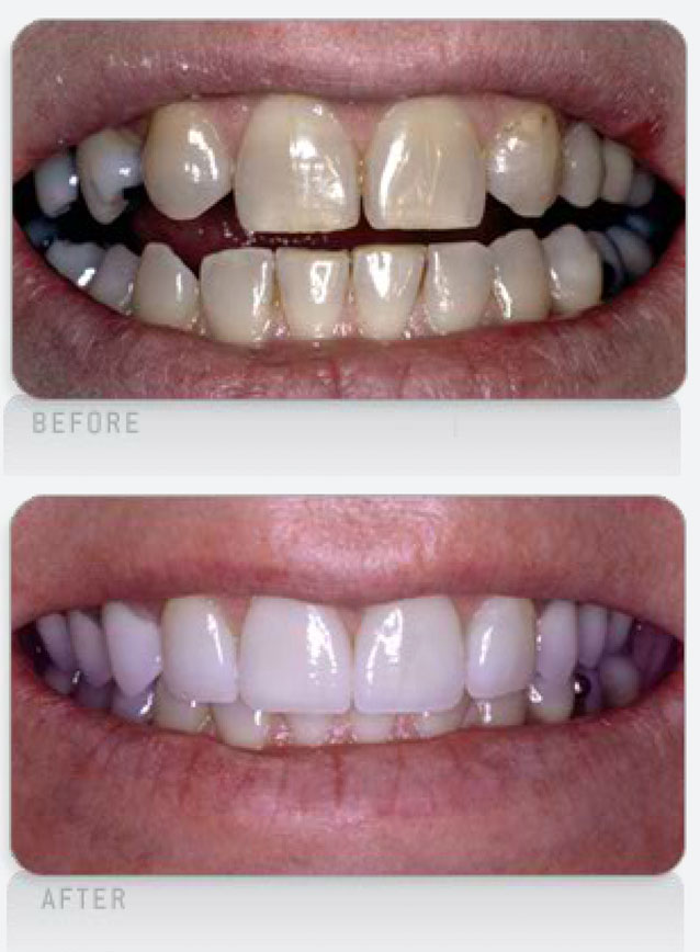 Stained-Teeth