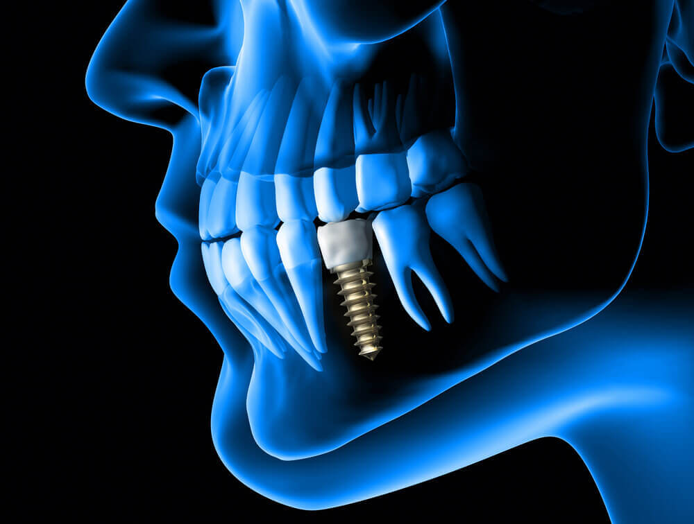 Dental Implant Failure