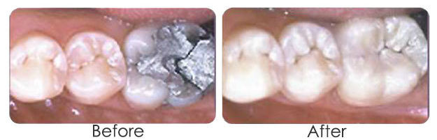 inlays_63e041deab50e07a19f780f3fe3f556b