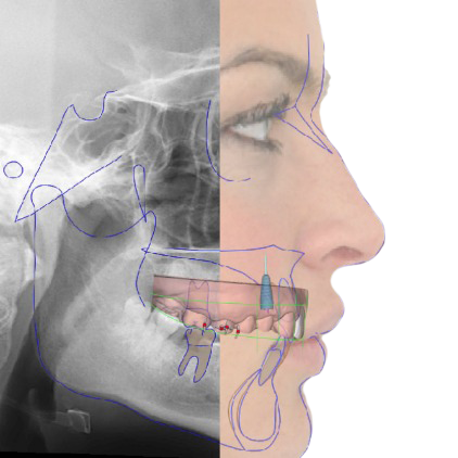 faceimplants-full_27ed9b35a39cfa75c0eba12ef9736eea