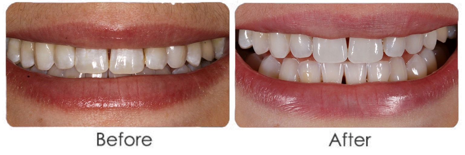 Microabrasion Microabrasion teeth ismile Best Dental Clinic NYC