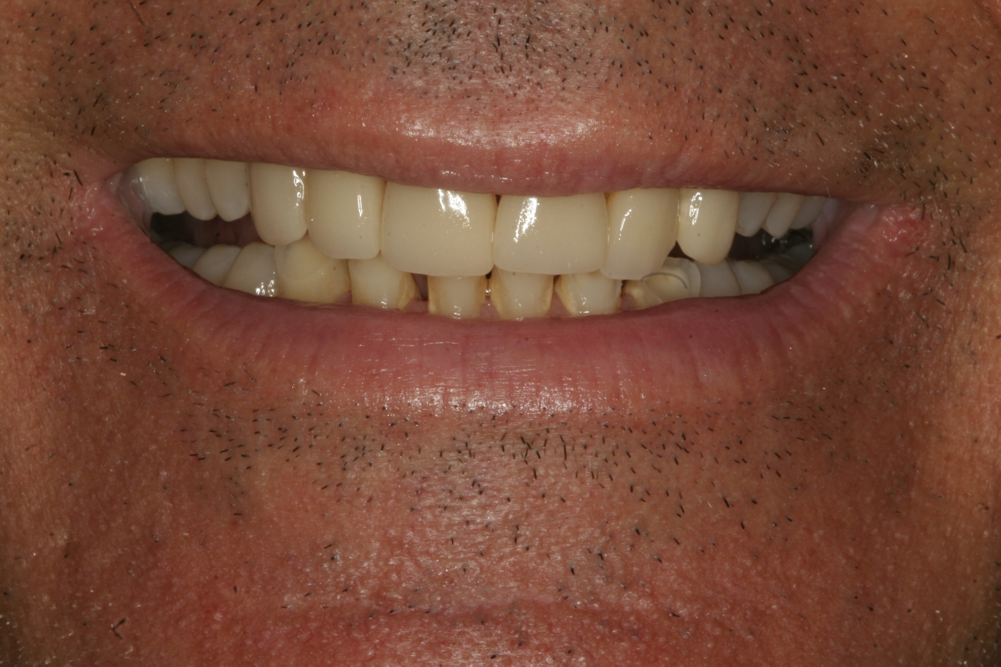 pre-op smile