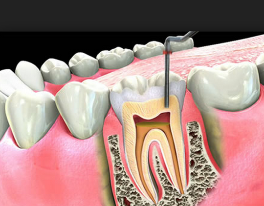 Tooth pain after root canal | ismile