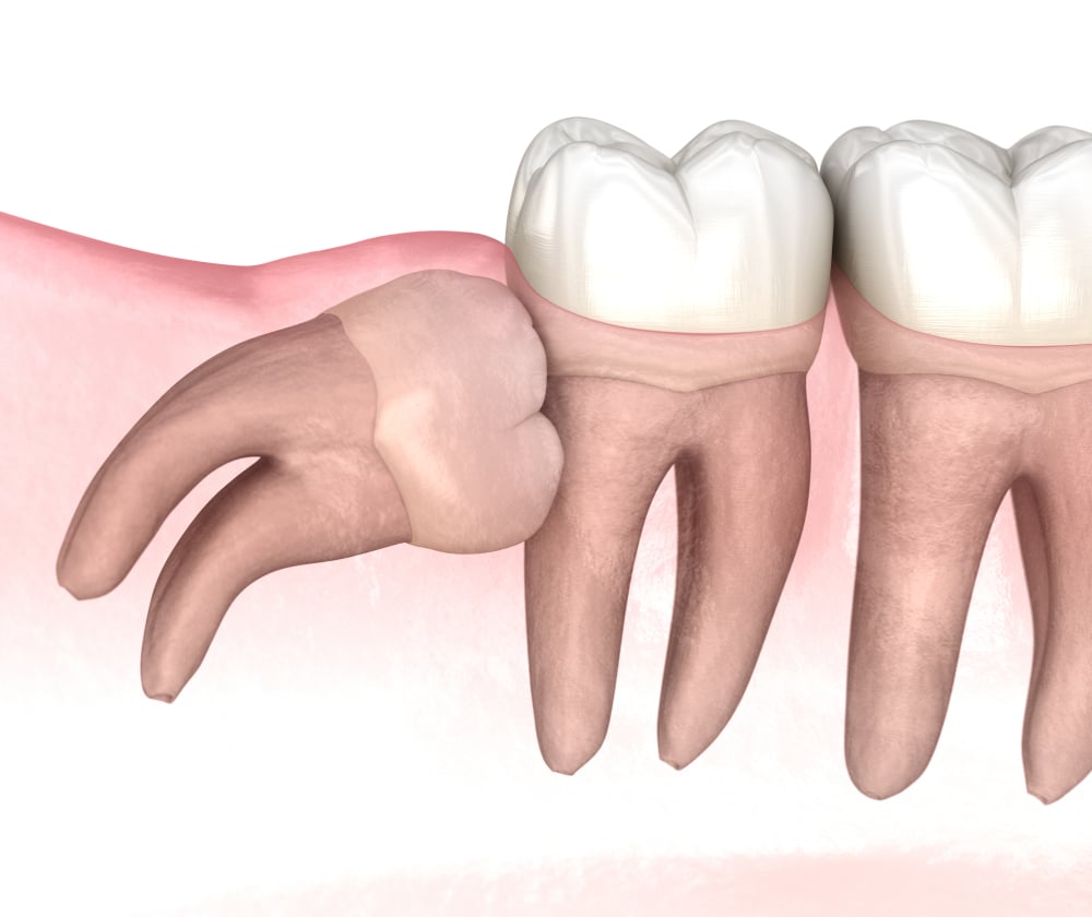 Wisdom Tooth Removal Surgery