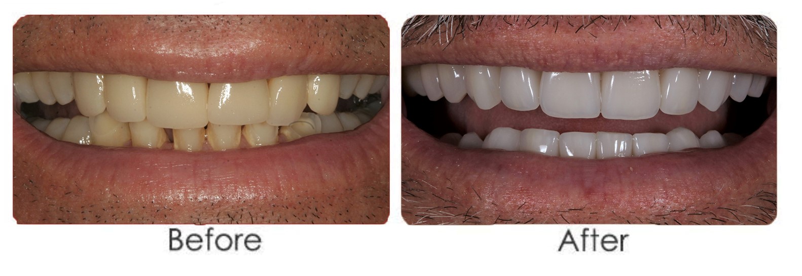 veneers1
