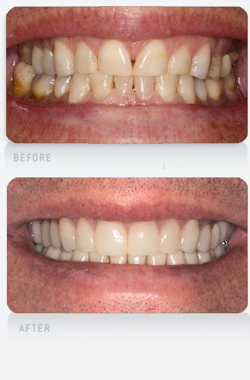 worn teeth hub