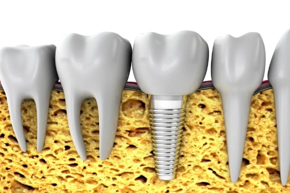 Ismile - Dental Implants
